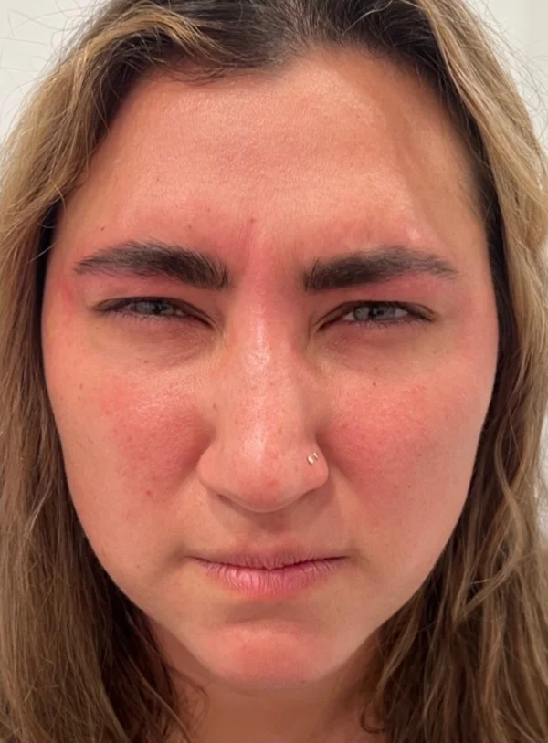 Frown lines after Botox at Back to 30