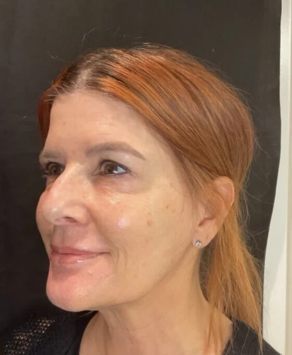 Skin after DiamondGlow and Botox at Back to 30