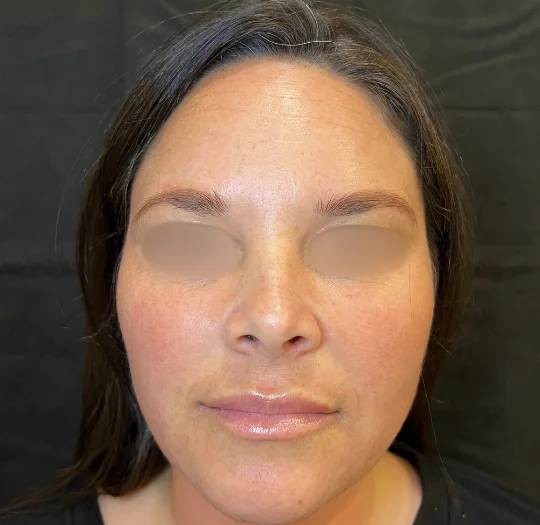 Face after facial balancing at Back to 30