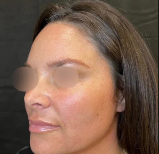 Profile after facial balancing at Back to 30