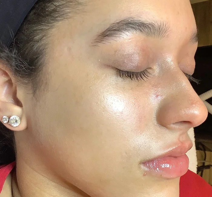 Clearer skin after IPL at Back to 30