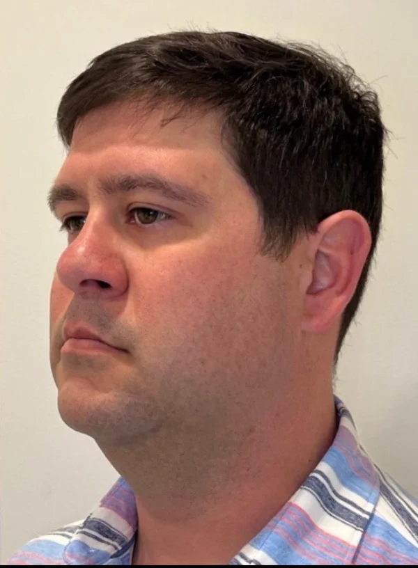 Chin profile after Kybella at Back to 30