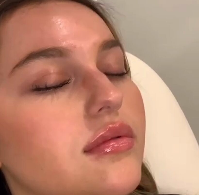 Lips after enhancement at Back to 30