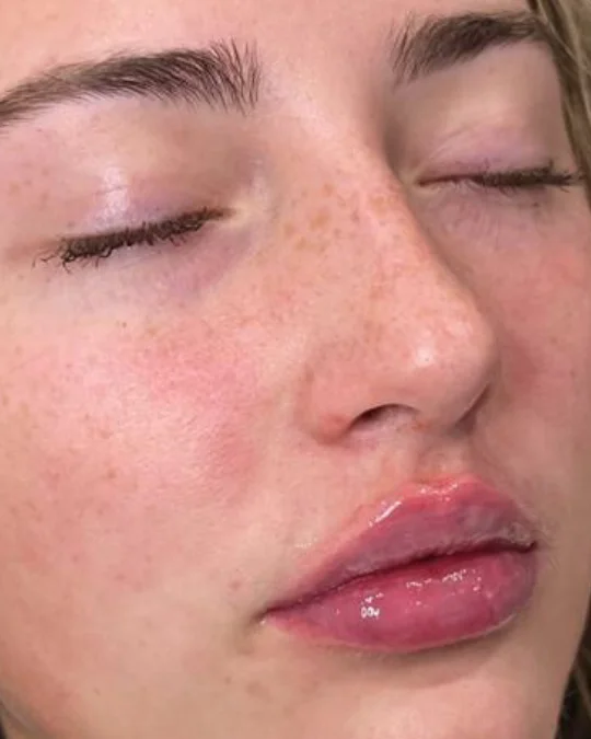 Lips after enhancement at Back to 30