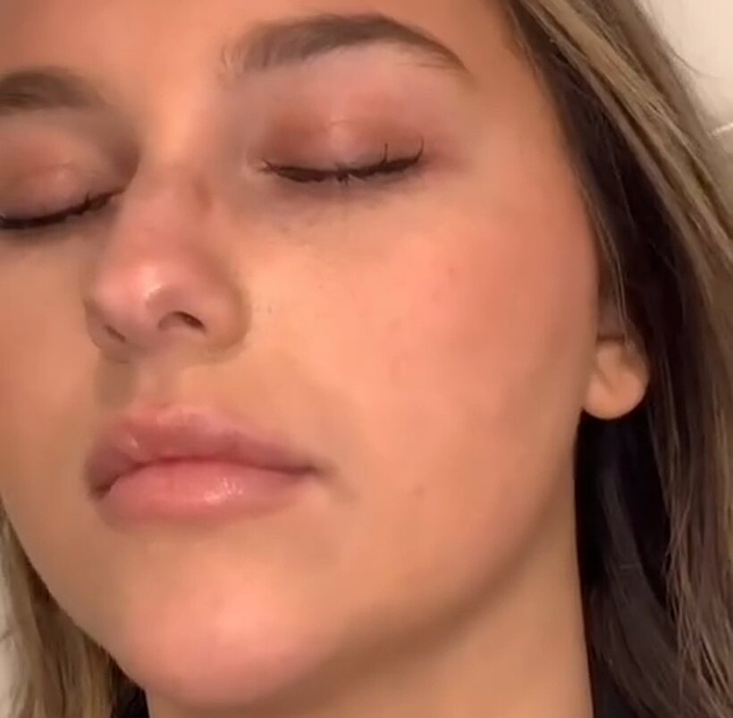 Lips before enhancement