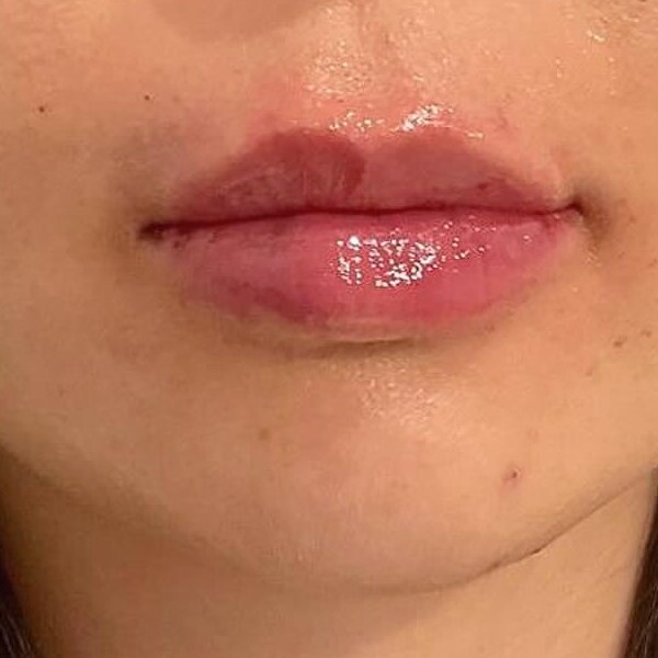 Lips after filler at Back to 30
