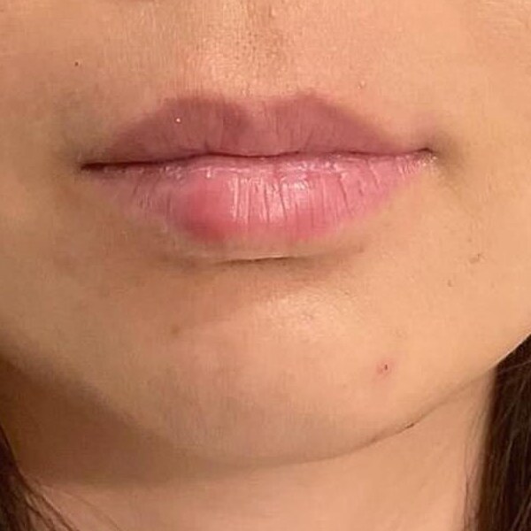 Lips before filler