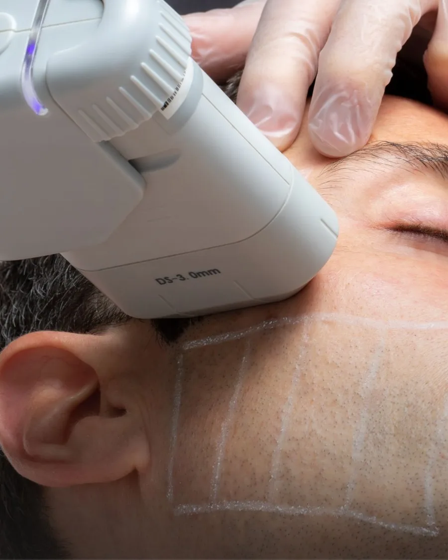 Ultherapy at Back to 30 Med Spa